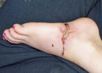 Why Ankle Wounds Require Special Attention for Full Recovery