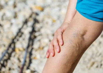 Managing Varicose Veins: Lifestyle Tips and Treatment Options