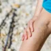 Managing Varicose Veins: Lifestyle Tips and Treatment Options