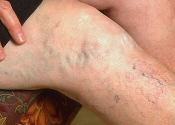 Varicose Veins and Exercise: Tips for Better Circulation